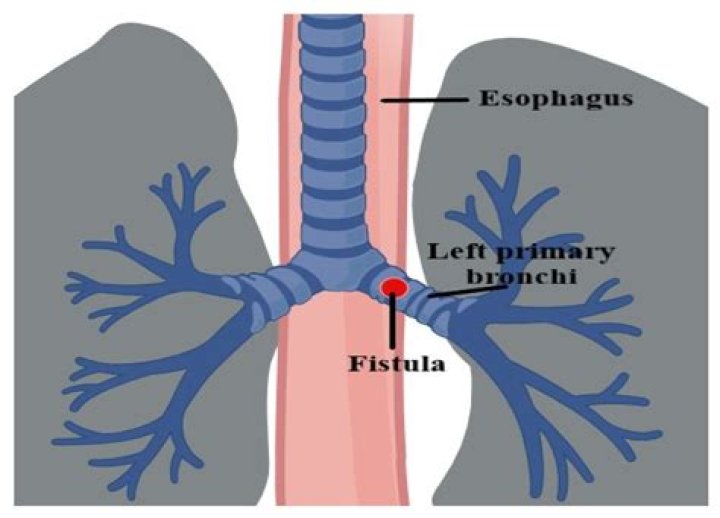 What is a bronchial flush?