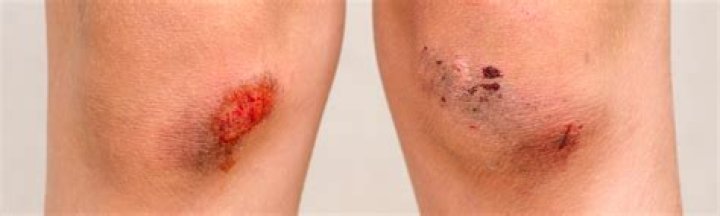 What is dermal necrosis?